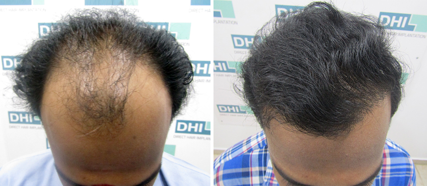 DHI before & after hair transplant results